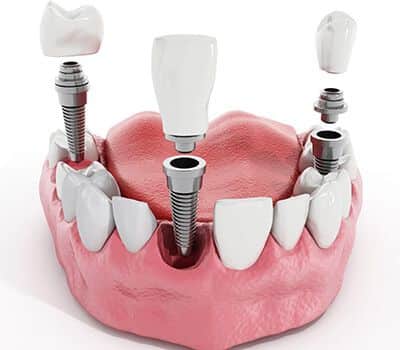 santa-rita-dental-implant