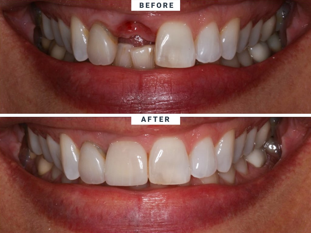 implante-antes-antes-despues-santa-rita-dental