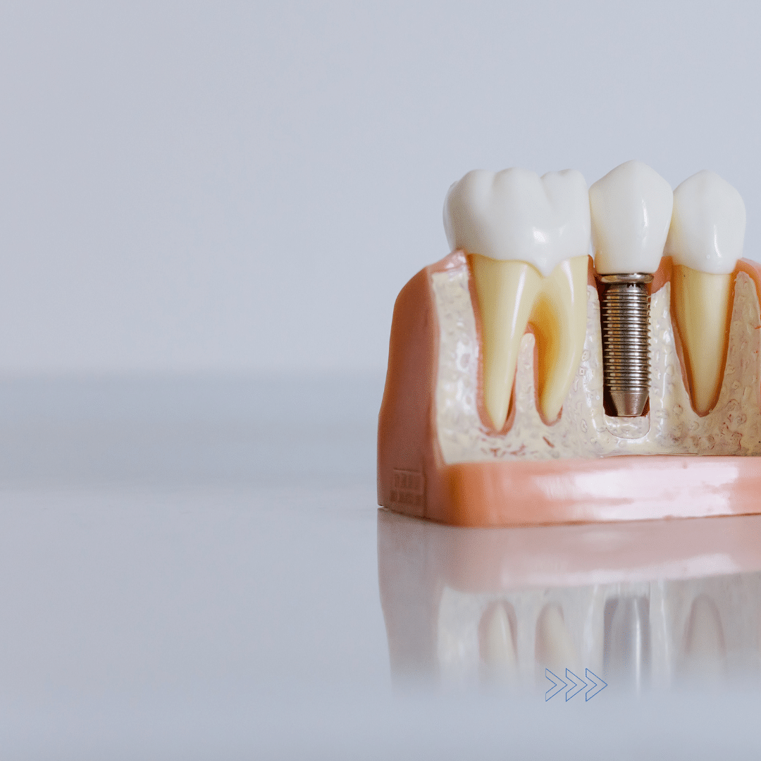 implant vs denture- santa rita dental