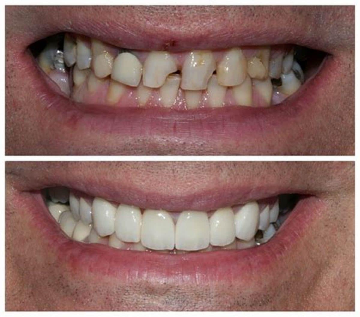 veneer-before-after-Santa-Rita-Dental