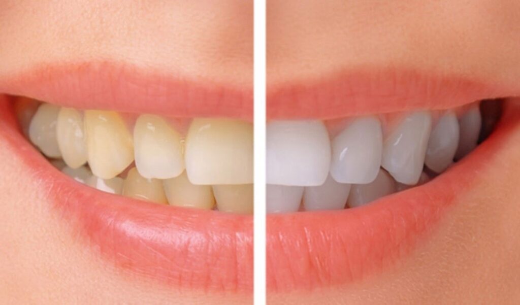 whitening-before-after-Santa-Rita-Dental