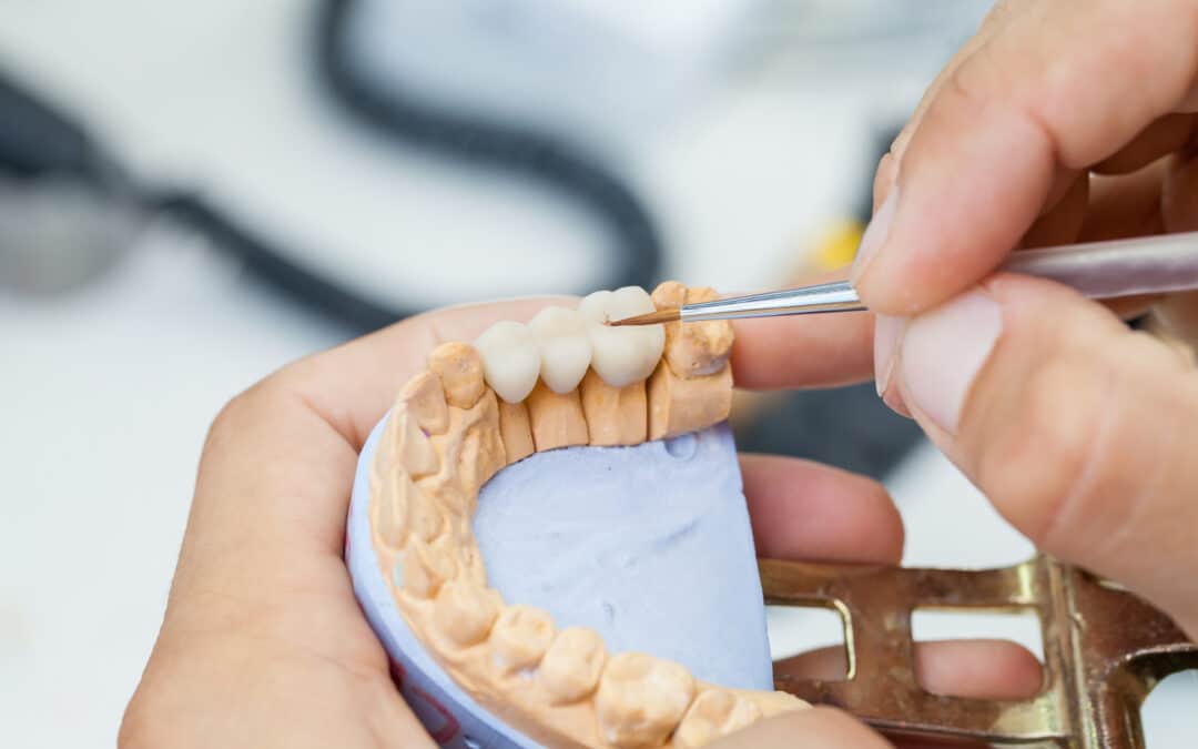 Dental Crowns Versus Veneers: Which Option Is Best for Me?